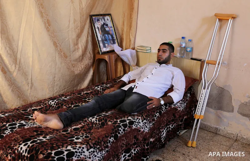 Palestinian disabled Mohammed Al Akhras, 32, who lost his leg by Israeli troops during clashes at Gaza-Israel border lies on his bed at his home in Rafah in the southern Gaza Strip on June 14, 2018. Since 30 March Israel...