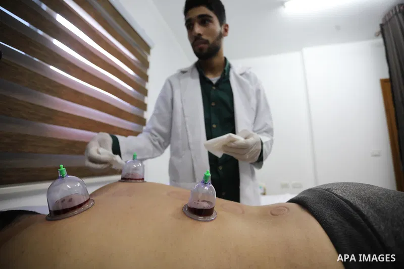 A Palestinian specialist performs Hajima, also knows as "wet cupping therapy", on a patient in Khan Younis in the southern of Gaza strip on September 26, 2021. Hijama is considered a traditional medical treatment in Isla...