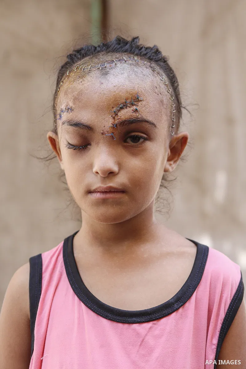 Sila Hoso, a 7-year-old Palestinian child who was seriously wounded in an Israeli attack on the town of Deir al-Balah is viewed in Deir al Balah, Gaza on August 13, 2024. Sila Hoso's treatment continues at Al-Aqsa Martyr...