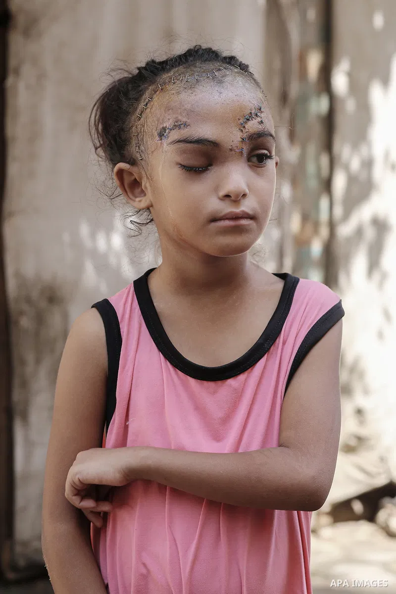 Sila Hoso, a 7-year-old Palestinian child who was seriously wounded in an Israeli attack on the town of Deir al-Balah is viewed in Deir al Balah, Gaza on August 13, 2024. Sila Hoso's treatment continues at Al-Aqsa Martyr...
