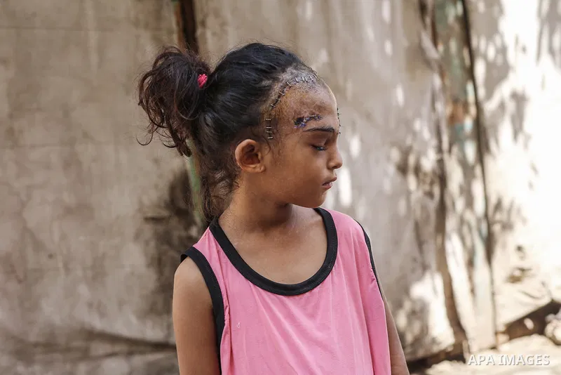 Sila Hoso, a 7-year-old Palestinian child who was seriously wounded in an Israeli attack on the town of Deir al-Balah is viewed in Deir al Balah, Gaza on August 13, 2024. Sila Hoso's treatment continues at Al-Aqsa Martyr...