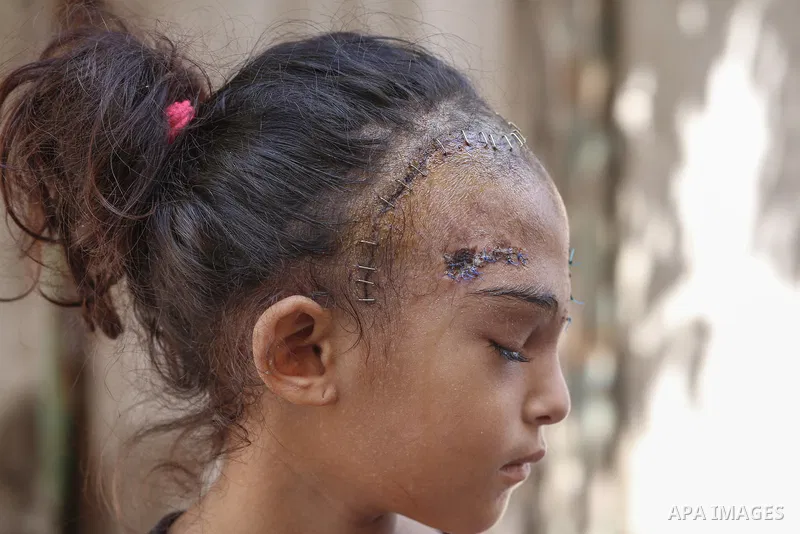Sila Hoso, a 7-year-old Palestinian child who was seriously wounded in an Israeli attack on the town of Deir al-Balah is viewed in Deir al Balah, Gaza on August 13, 2024. Sila Hoso's treatment continues at Al-Aqsa Martyr...