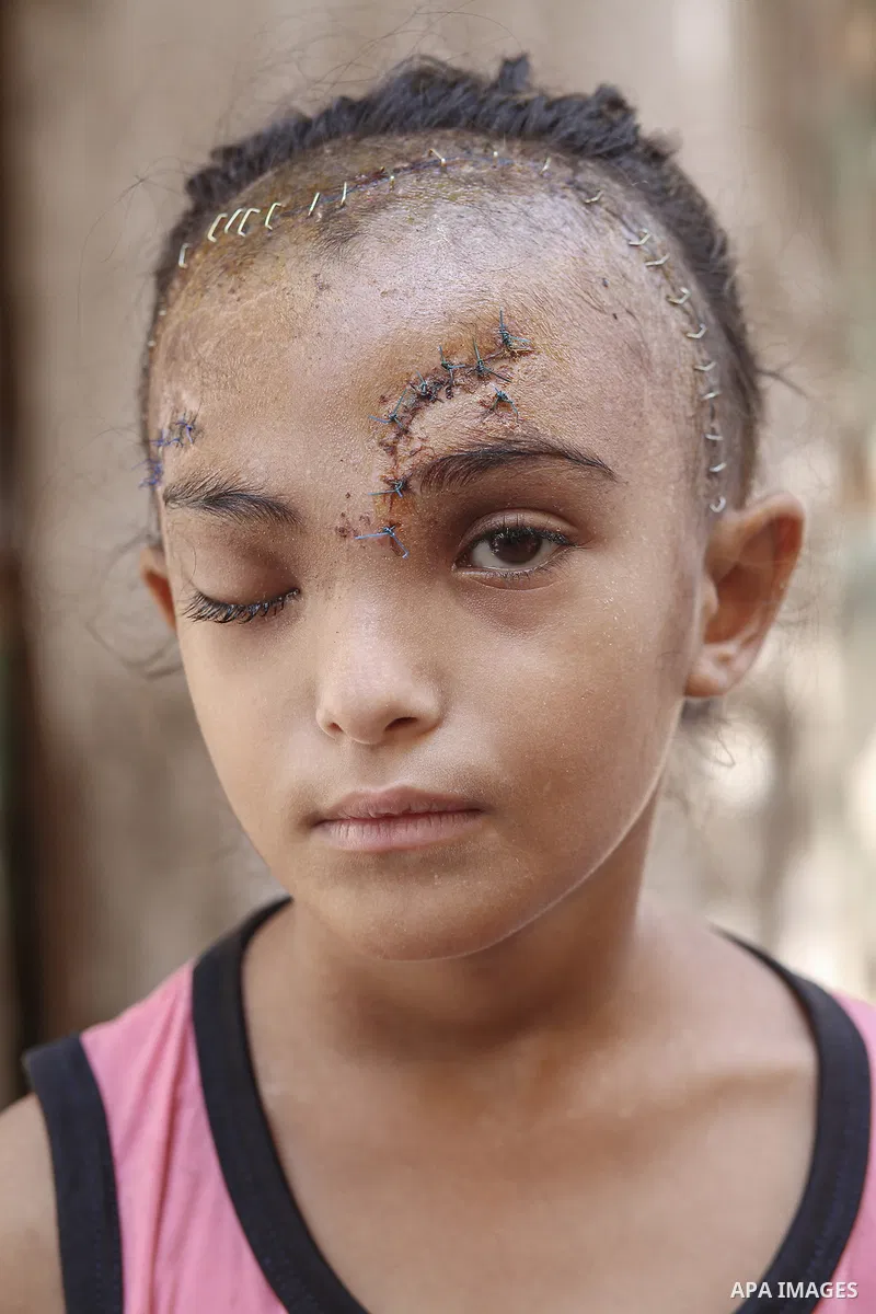 Sila Hoso, a 7-year-old Palestinian child who was seriously wounded in an Israeli attack on the town of Deir al-Balah is viewed in Deir al Balah, Gaza on August 13, 2024. Sila Hoso's treatment continues at Al-Aqsa Martyr...