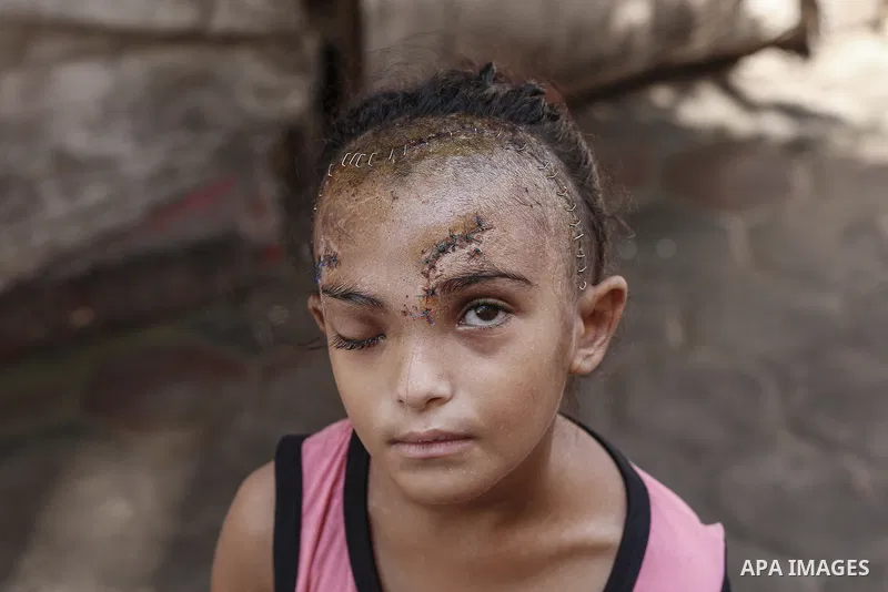 Sila Hoso, a 7-year-old Palestinian child who was seriously wounded in an Israeli attack on the town of Deir al-Balah is viewed in Deir al Balah, Gaza on August 13, 2024. Sila Hoso's treatment continues at Al-Aqsa Martyr...