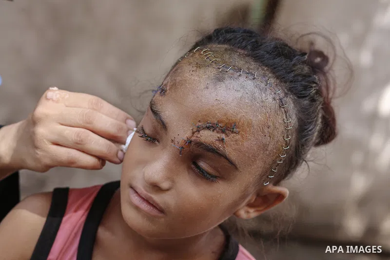 Sila Hoso, a 7-year-old Palestinian child who was seriously wounded in an Israeli attack on the town of Deir al-Balah is viewed in Deir al Balah, Gaza on August 13, 2024. Sila Hoso's treatment continues at Al-Aqsa Martyr...