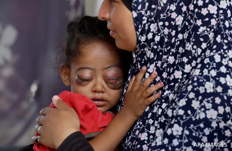 A Palestinian Two-year-old Jana Al-Khawli, is receiving care from her family in a tent inside a shelter for displaced people west of the Al-Zawaida area in the central Gaza Strip, on 30 September 2024. Jana suffers from...