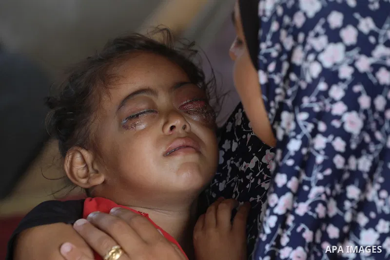 A Palestinian Two-year-old Jana Al-Khawli, is receiving care from her family in a tent inside a shelter for displaced people west of the Al-Zawaida area in the central Gaza Strip, on 30 September 2024. Jana suffers from...
