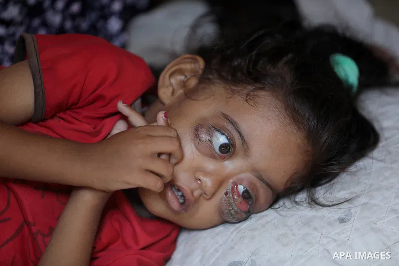 A Palestinian Two-year-old Jana Al-Khawli, is receiving care from her family in a tent inside a shelter for displaced people west of the Al-Zawaida area in the central Gaza Strip, on 30 September 2024. Jana suffers from...