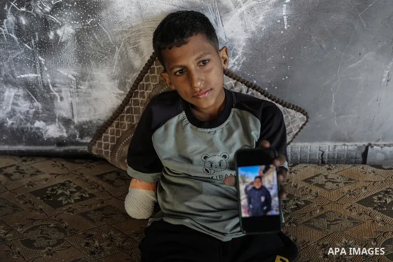 Ahmad Agha, a 14-year-old boy living in a shelter in Gaza City, who was seriously wounded in the attack on his school, is viewed on June 2, 2025 in Gaza City, Gaza. Ahmad, who lost his right arm in the attack, suffered s...
