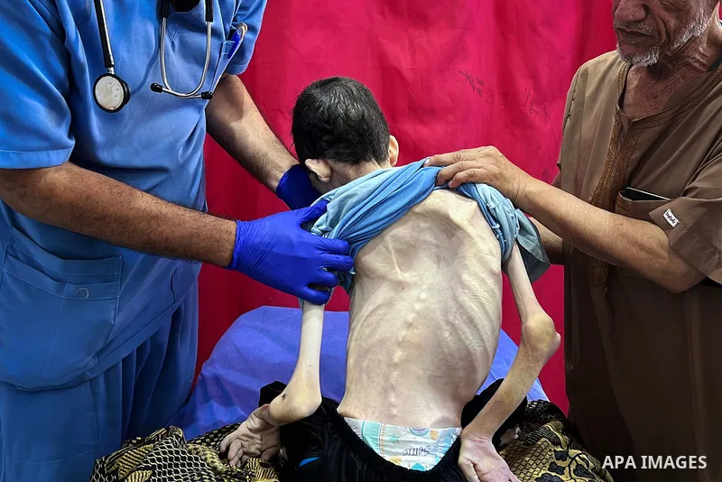 Body of 25-year-old Palestinian Karam Khaled al-Jamal, who lost his life due to malnutrition, is brought to al-Awda Hospital at Nuseirat Camp in Gaza City, Gaza on July 31, 2025. Photo by Belal Abu Amer \ apaimages