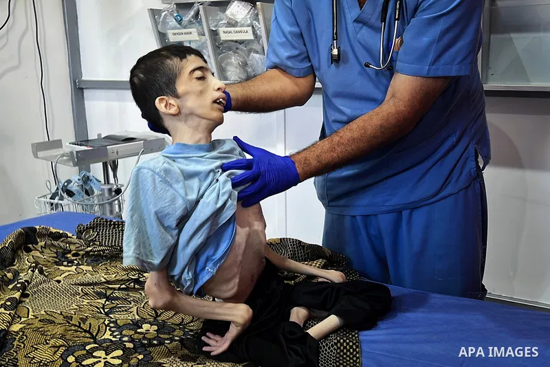 Body of 25-year-old Palestinian Karam Khaled al-Jamal, who lost his life due to malnutrition, is brought to al-Awda Hospital at Nuseirat Camp in Gaza City, Gaza on July 31, 2025. Photo by Belal Abu Amer \ apaimages