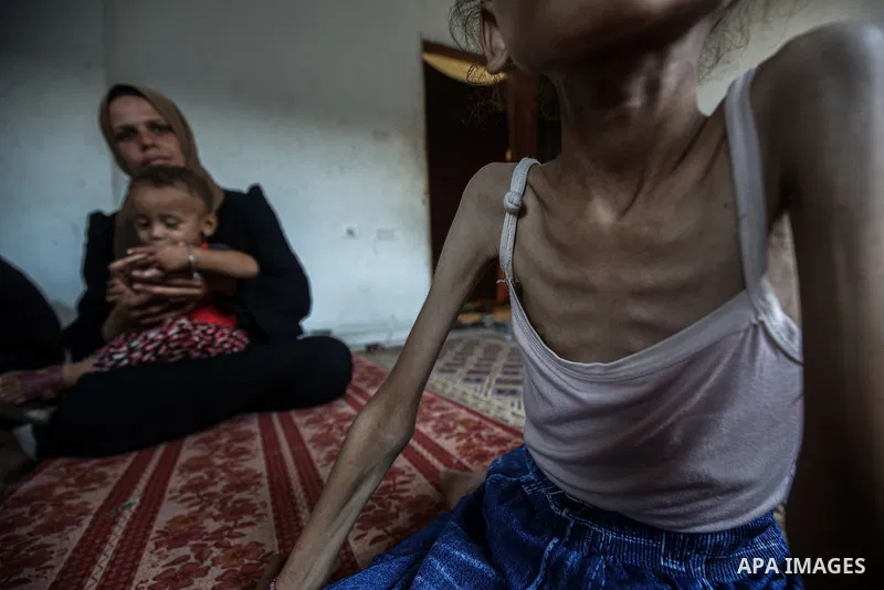 9 years-old Maryam Abdulaziz Mahmoud Davvas, who took shelter with her family at a displacement center due to ongoing Israeli attacks, has become unable to walk due to severe malnutrition in Gaza City, on August 2, 2025....