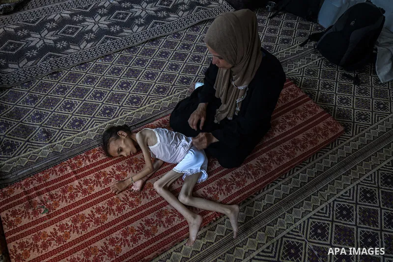 9 years-old Maryam Abdulaziz Mahmoud Davvas, who took shelter with her family at a displacement center due to ongoing Israeli attacks, has become unable to walk due to severe malnutrition in Gaza City, on August 2, 2025....