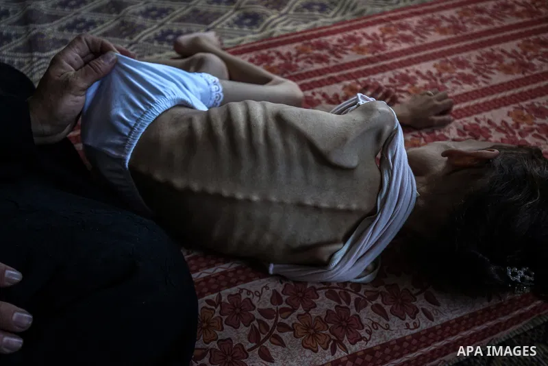 9 years-old Maryam Abdulaziz Mahmoud Davvas, who took shelter with her family at a displacement center due to ongoing Israeli attacks, has become unable to walk due to severe malnutrition in Gaza City, on August 2, 2025....
