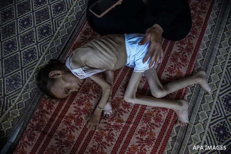 9 years-old Maryam Abdulaziz Mahmoud Davvas, who took shelter with her family at a displacement center due to ongoing Israeli attacks, has become unable to walk due to severe malnutrition in Gaza City, on August 2, 2025....