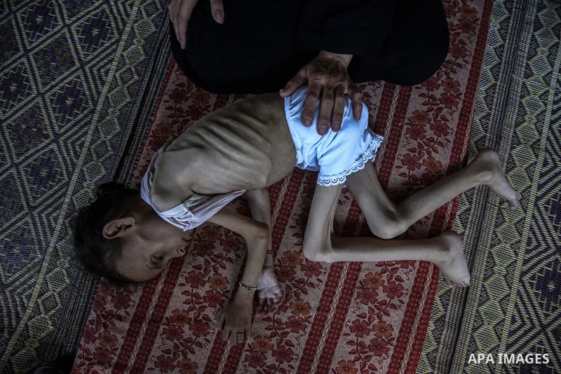 9 years-old Maryam Abdulaziz Mahmoud Davvas, who took shelter with her family at a displacement center due to ongoing Israeli attacks, has become unable to walk due to severe malnutrition in Gaza City, on August 2, 2025....