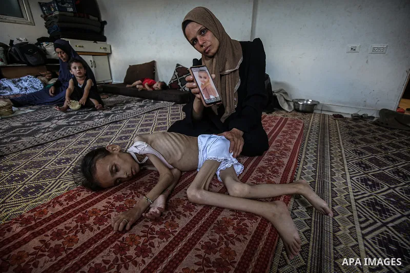 9 years-old Maryam Abdulaziz Mahmoud Davvas, who took shelter with her family at a displacement center due to ongoing Israeli attacks, has become unable to walk due to severe malnutrition in Gaza City, on August 2, 2025....