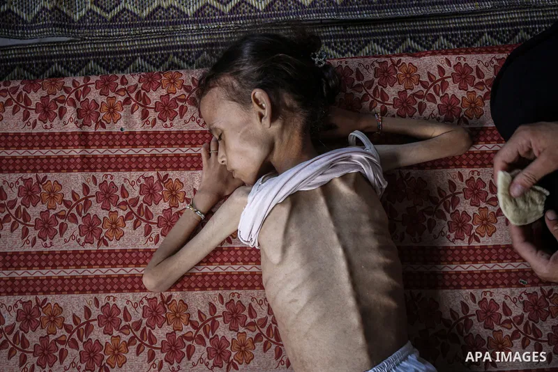 9 years-old Maryam Abdulaziz Mahmoud Davvas, who took shelter with her family at a displacement center due to ongoing Israeli attacks, has become unable to walk due to severe malnutrition in Gaza City, on August 2, 2025....