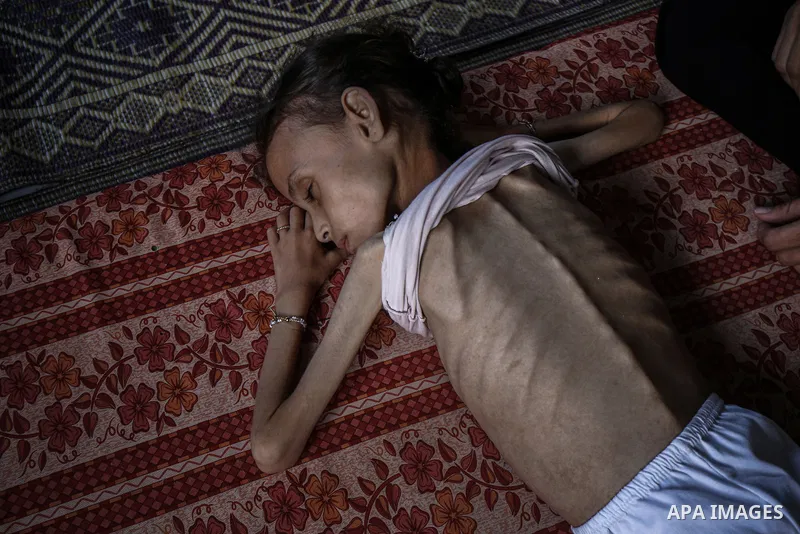 9 years-old Maryam Abdulaziz Mahmoud Davvas, who took shelter with her family at a displacement center due to ongoing Israeli attacks, has become unable to walk due to severe malnutrition in Gaza City, on August 2, 2025....