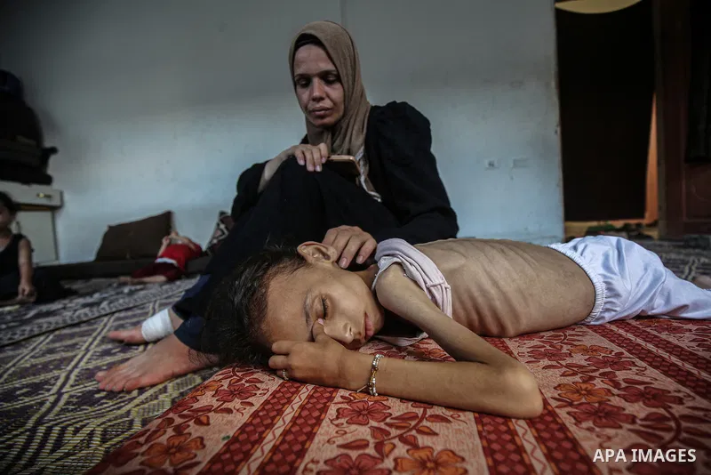 9 years-old Maryam Abdulaziz Mahmoud Davvas, who took shelter with her family at a displacement center due to ongoing Israeli attacks, has become unable to walk due to severe malnutrition in Gaza City, on August 2, 2025....