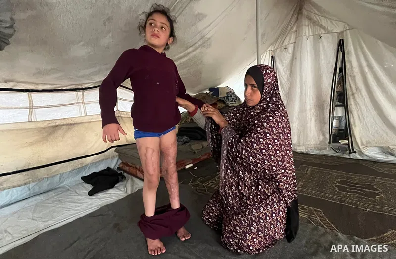 Palestinian child Raneen Jundiya suffered burns to her feet and other parts of her body while trying to escape an Israeli airstrike that targeted a tent near her displacement site in Khan Younis, southern Gaza Strip. Ran...