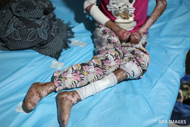 Palestinian woman Sundus al-Jarousha, 23, who suffers from malnutrition, bone atrophy and epidermolysis bullosa, a rare inherited skin disorder commonly known as “butterfly skin disease,” receives treatment at Al-Awda Ho...