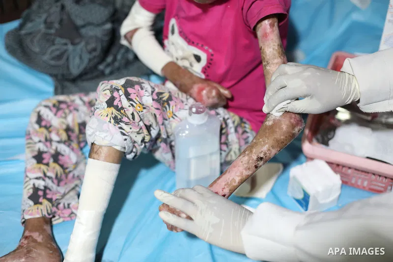 Palestinian woman Sundus al-Jarousha, 23, who suffers from malnutrition, bone atrophy and epidermolysis bullosa, a rare inherited skin disorder commonly known as “butterfly skin disease,” receives treatment at Al-Awda Ho...